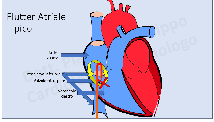 Il Flutter Atriale cosa è e come si tratta cardiologoravennaplacentino